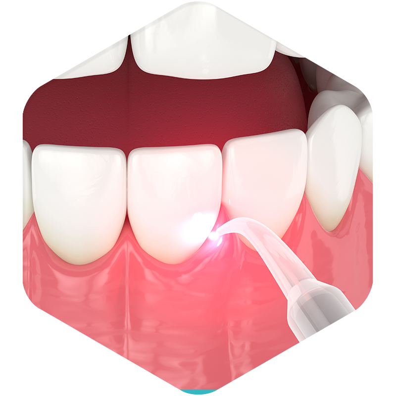 3D illustration of a tooth undergoing a dental cleaning.